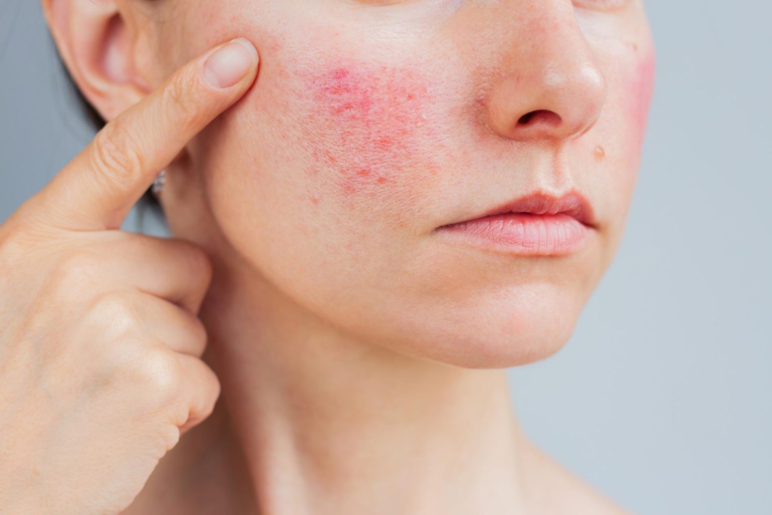 Rosacea Wart Removal