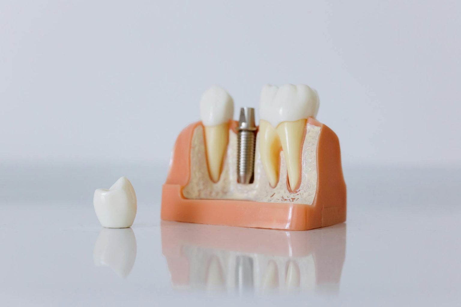 The Benefits of Custom-made Dental Implants for a Perfect Fit Custom-made Dental Implants