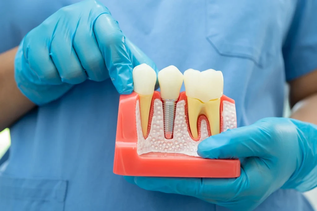 Types of Dental Implants