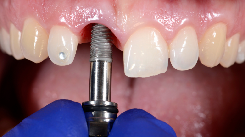 Dental Implant Options for Different Oral Issues Dental Implant Options