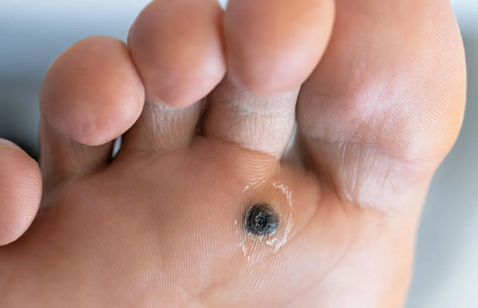 Helpful Things To Know About Warts
