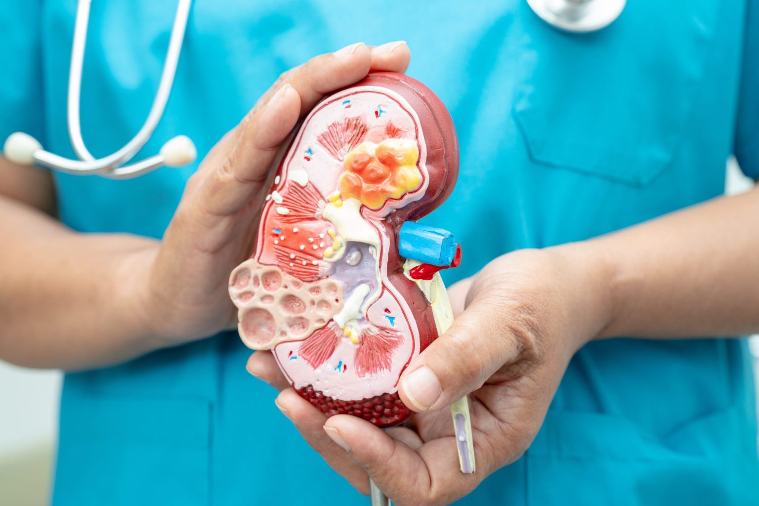 Interventional Radiology for Non-surgical Treatment of Kidney Stones Non-surgical Treatment of Kidney Stones