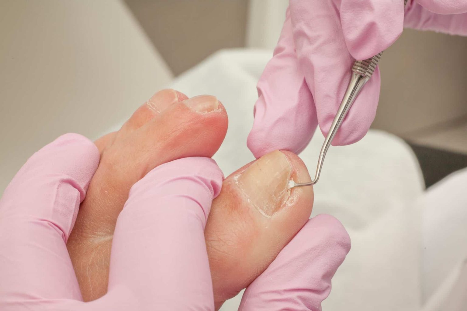 Understanding the Surgical Options for Ingrown Toenails Surgical Options for Ingrown Toenails