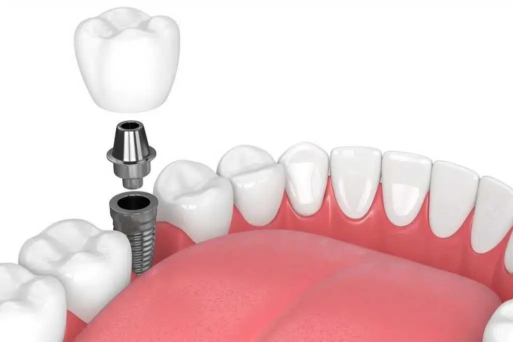 Things To Review When Choosing Dental Implants Dental Implants
