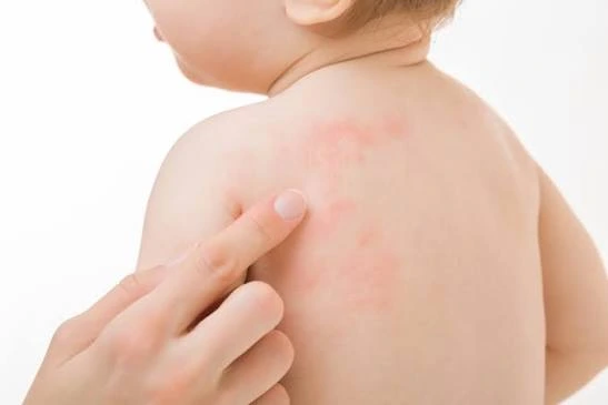 Recognizing and Treating Drug Allergies in Children Drug Allergies in Children