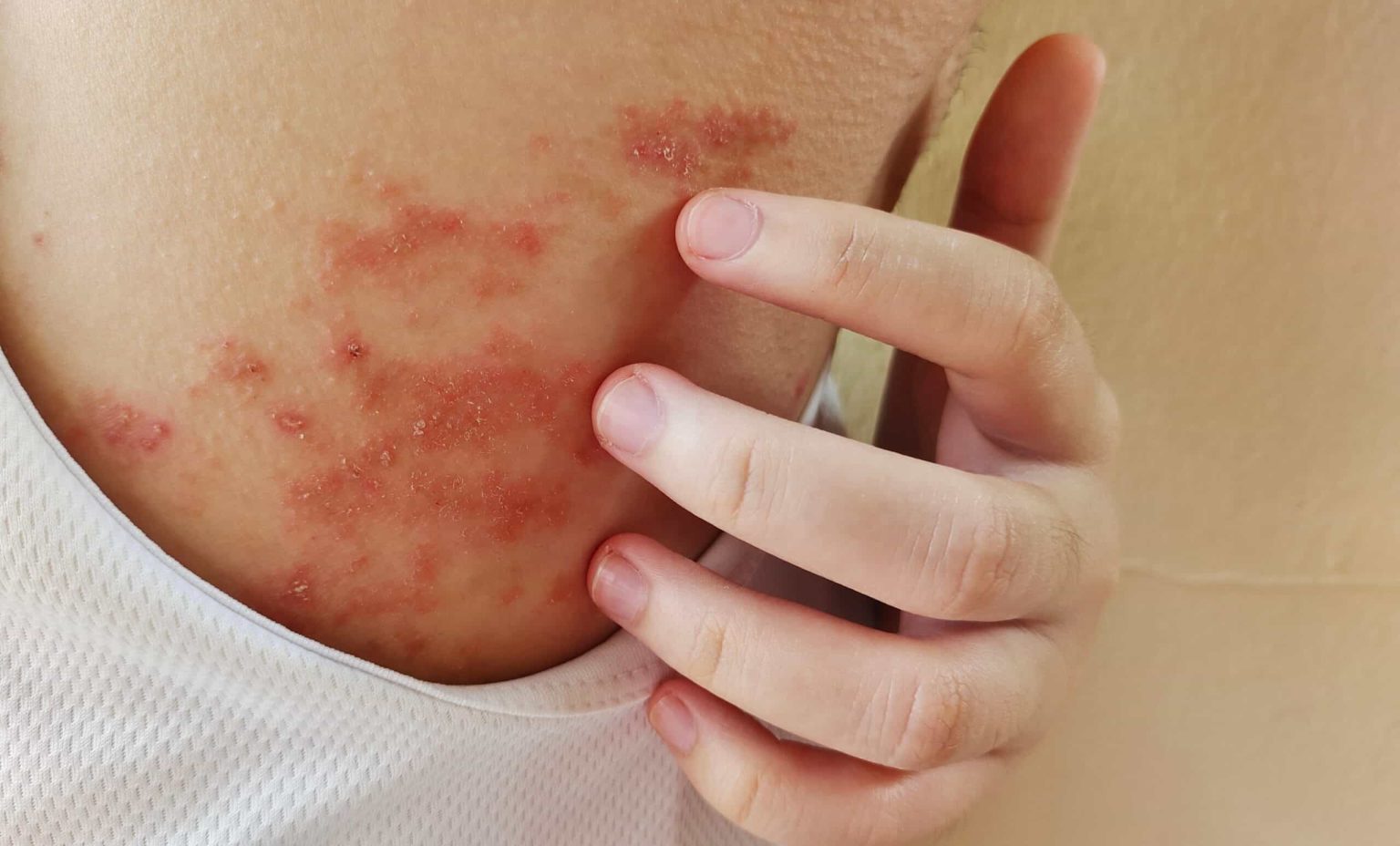 Eczema Triggers