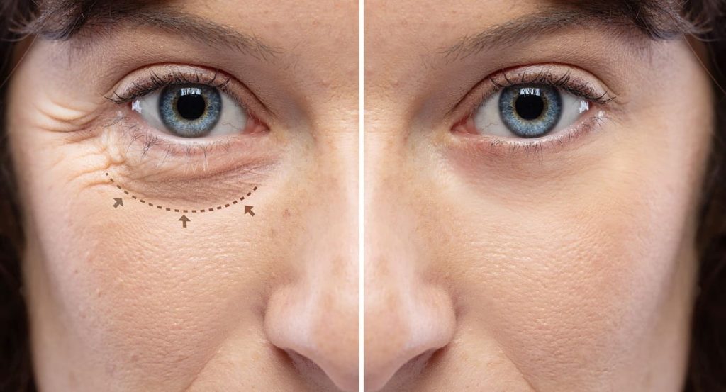 Efficacy of Blepharoplasty