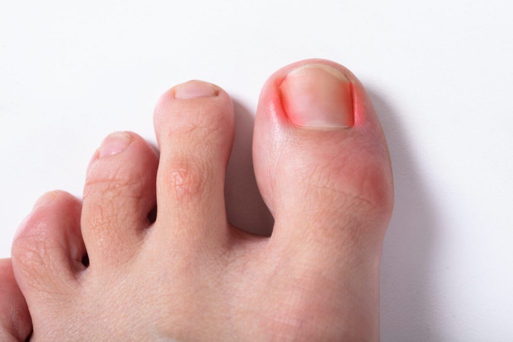 Preventative Measures and Treatments for Ingrown Toenails Ingrown Toenails