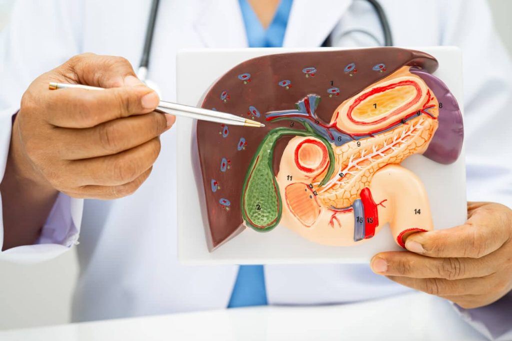 Managing Gallstones