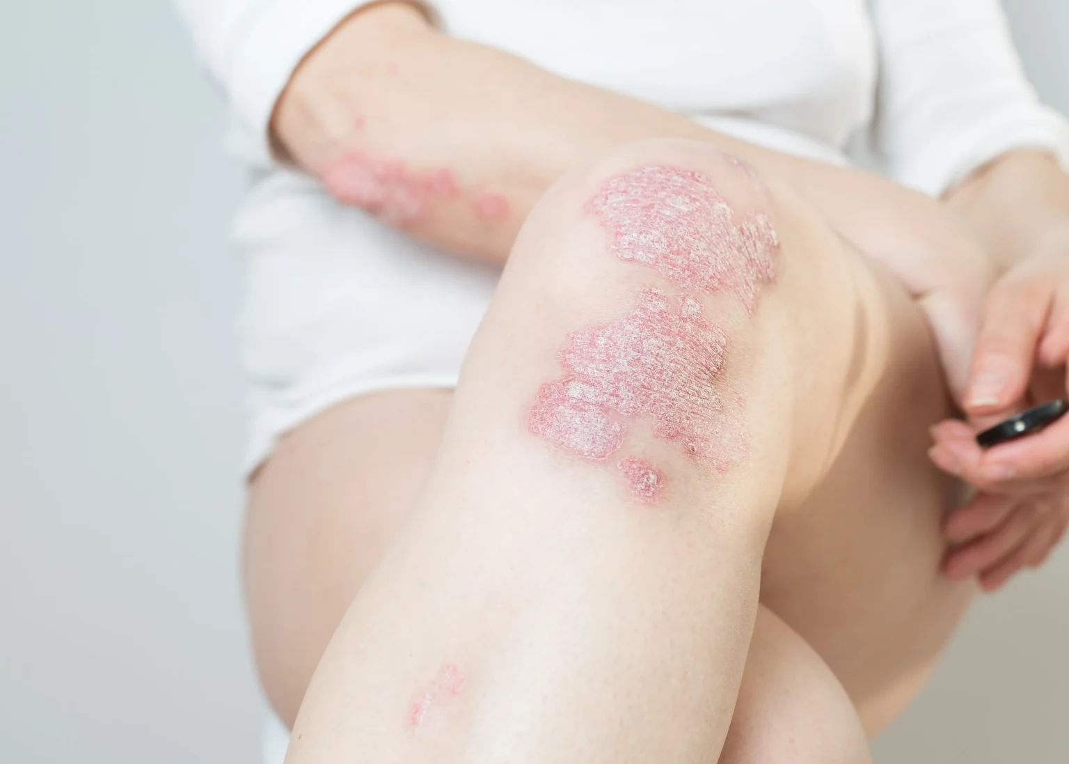 Psoriasis and Lifestyle Choices