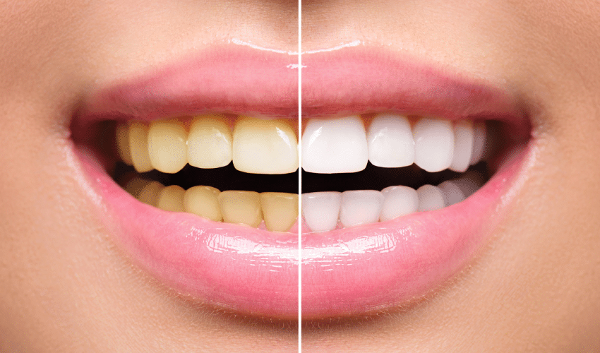 How To Choose the Right Teeth Whitening Method Teeth Whitening Method