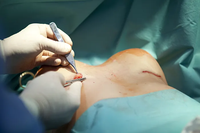 Reasons Someone Might Need Breast Surgery Breast Surgery