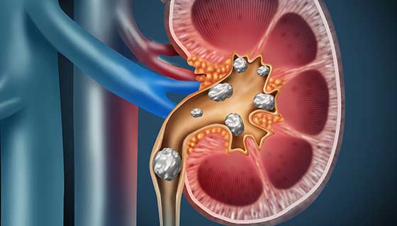 How Kidney Stones Form, and How to Prevent Them Kidney Stones