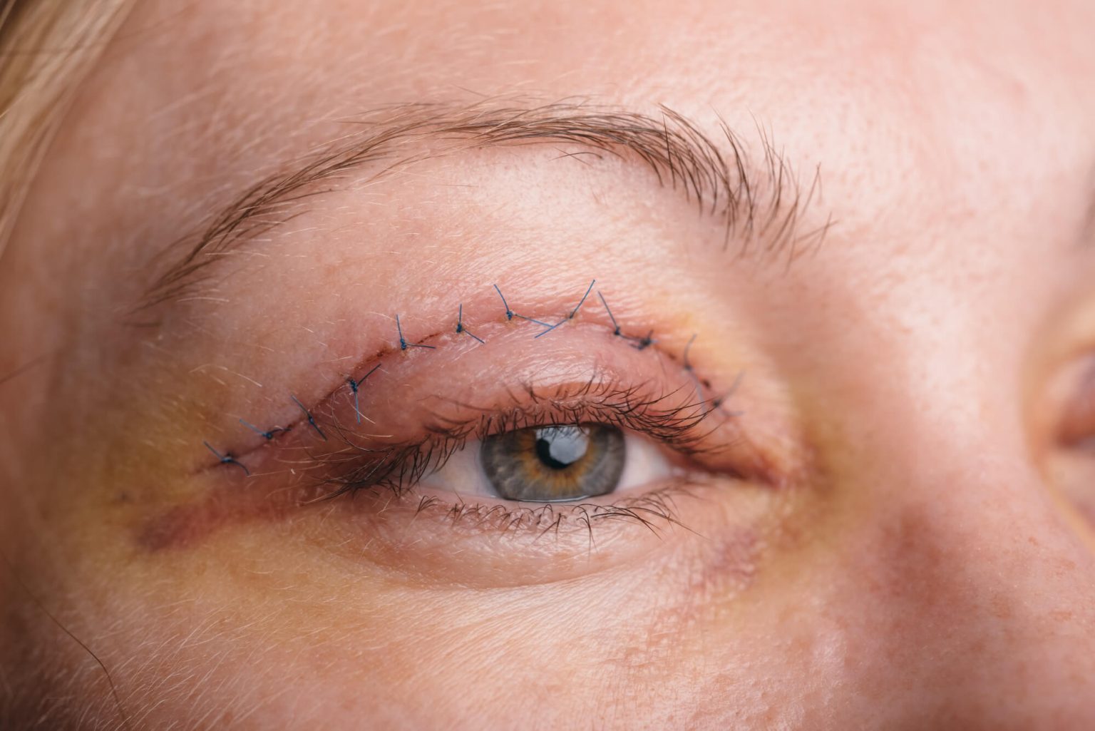 Recovery Process After Eye Surgery