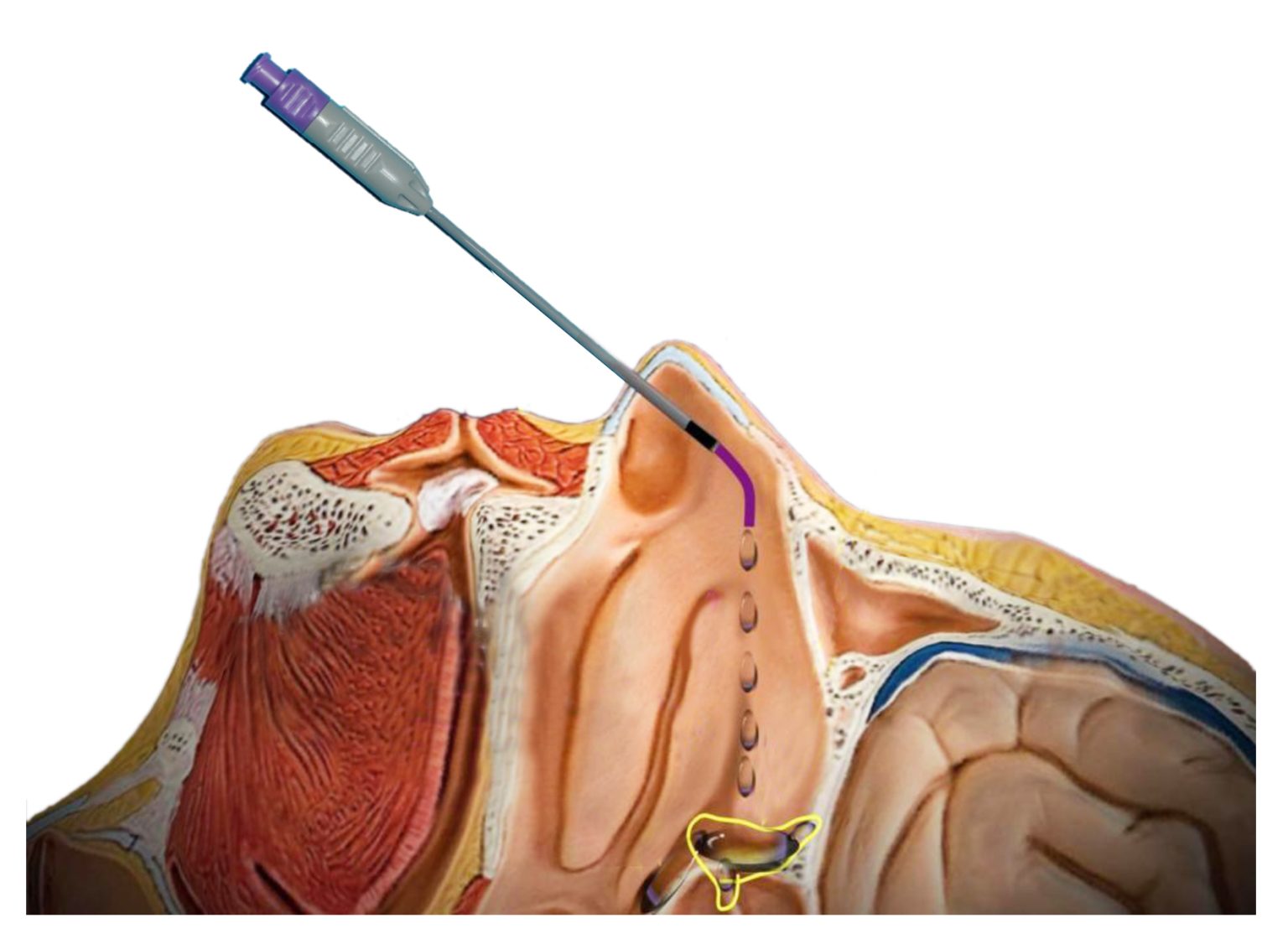 SPG Blocks for Migraine Relief