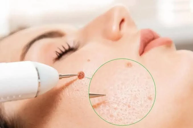 Understanding the Different Techniques in Skin Cancer Surgery Skin Cancer Surgery