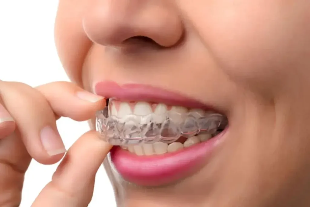 Understanding the Benefits of Invisalign for Adult Orthodontics Invisalign for Adult Orthodontics