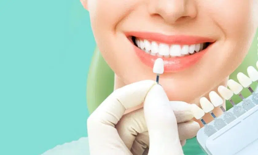 What To Expect During the Process of Applying Veneers Veneers